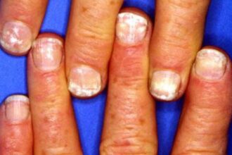 nail spot