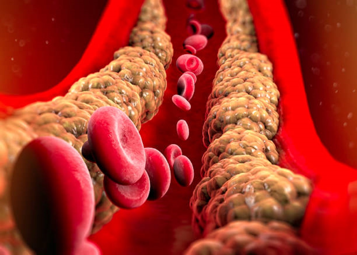 bad cholesterol