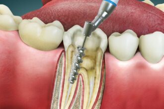 root canal teeth