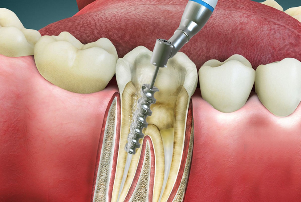 root canal teeth