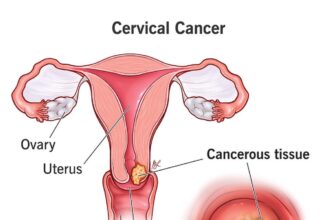 cervical cancer