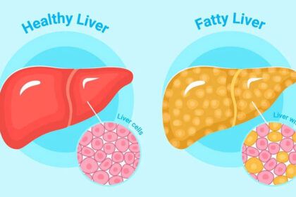 fatty liver