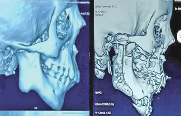 Free Jaw Surgery at Gujarat Public Hospital: 20 વર્ષથી ભોજન માટે તરસી રહી હતી, સિવિલમાં જટિલ સર્જરી બાદ હવે ખોરાક લઈ શકશે! જાણો આ કિસ્સાની સંપૂર્ણ વિગત 1 dfdf