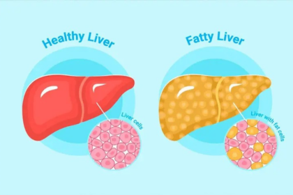 Fatty Liver Symptoms