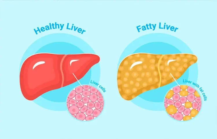 Fatty Liver Symptoms