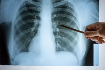 World TB Day 2025