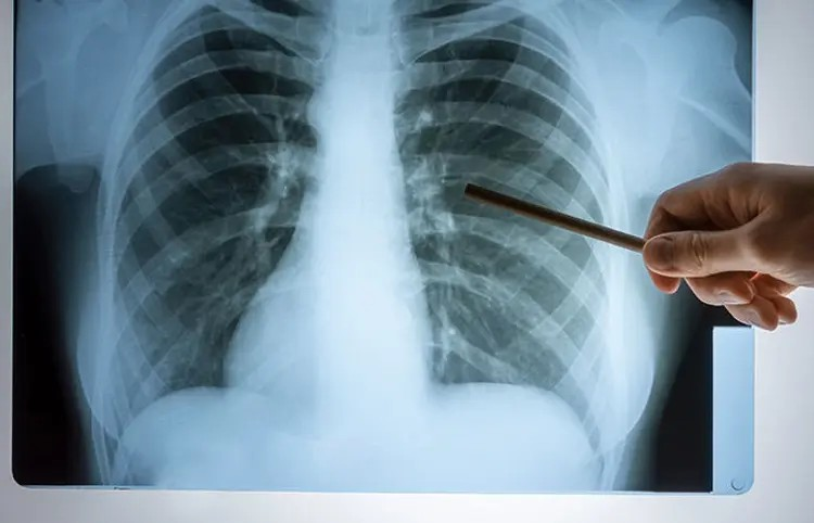 World TB Day 2025