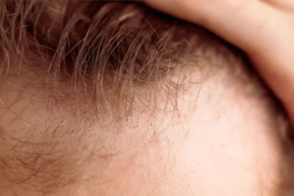 Hair loss problem