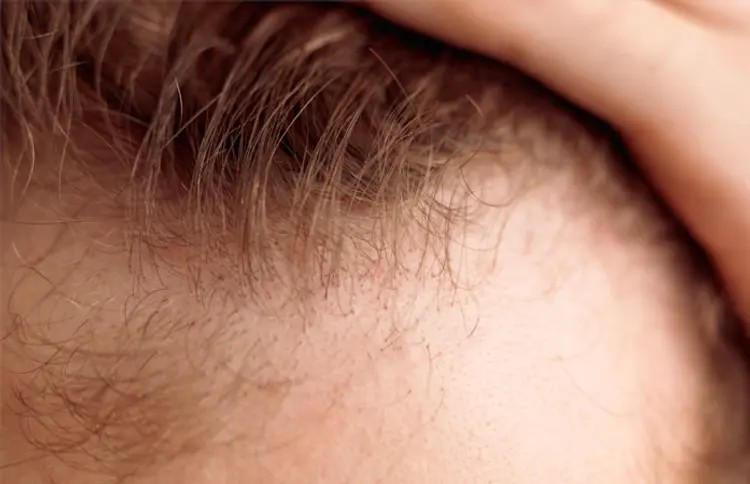 Hair loss problem: ટાલ રોકવા દેશી ઉપાય, ખાસ કરીને ભારતીય પુરુષો માટે 1 Hair loss problem