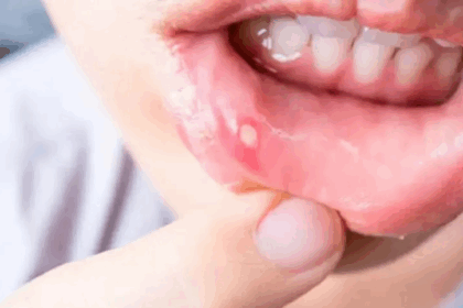Mouth Ulcer