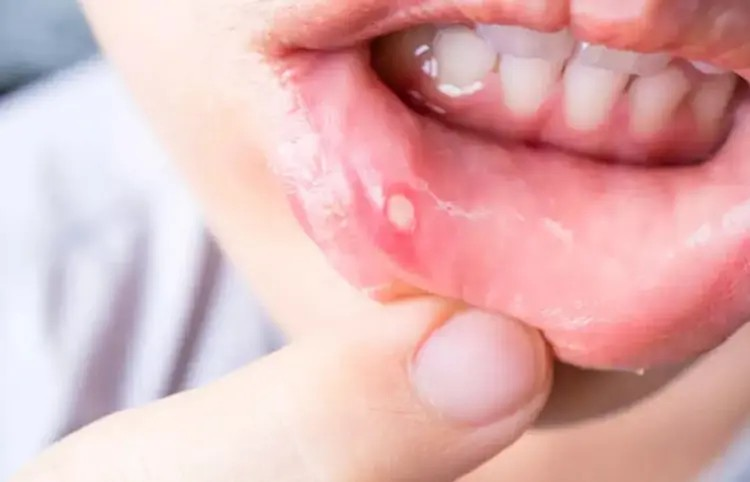Mouth Ulcer