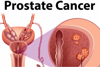 Prostate cancer