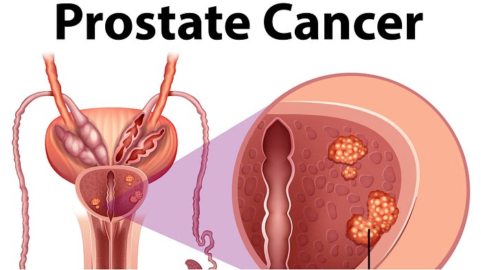 Prostate cancer