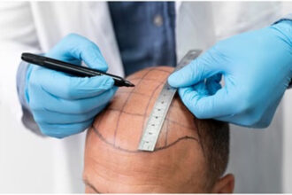 Hair Transplant & Complication
