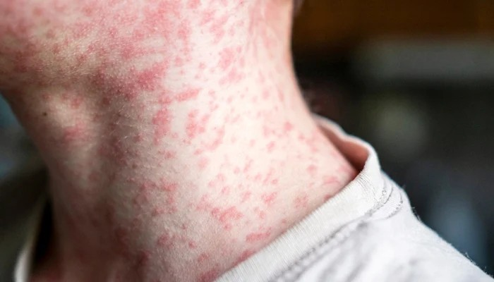 Measles in USA: અમેરિકામાં ખતરનાક બીમારીનો પ્રકોપ, 7 રાજ્યોમાં 700 થી વધુ લોકો પ્રભાવિત 1 Measles in USA