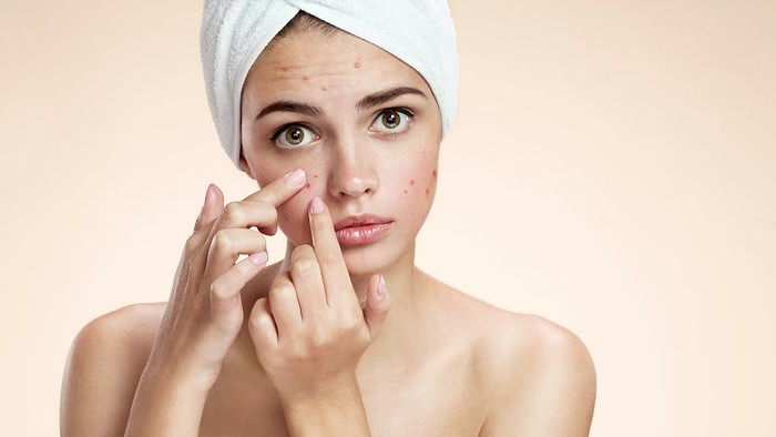 Remedies To Reduce Pimples