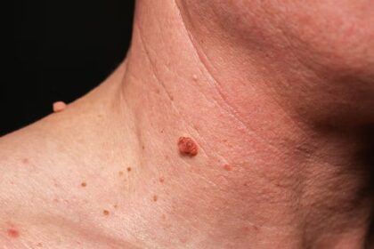 What is Warts
