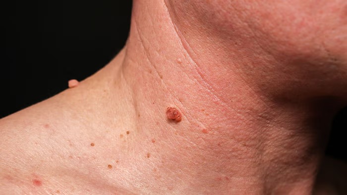 What is Warts