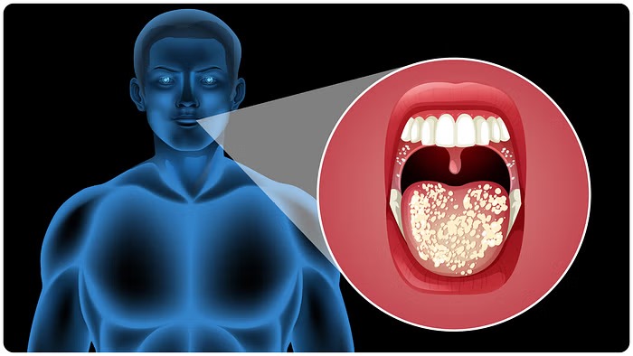 What causes recurrent mouth ulcers