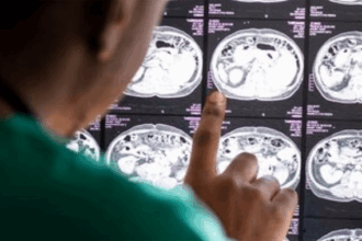 Treatment of Glioblastoma