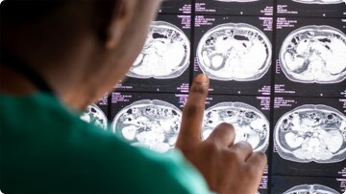 Treatment of Glioblastoma