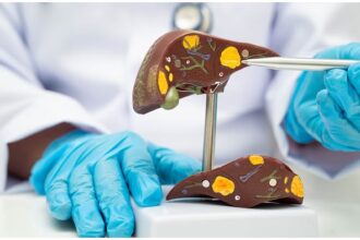 Fatty Liver Symptoms