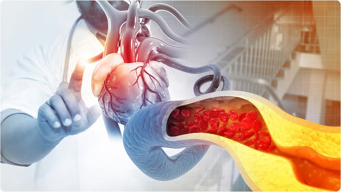 Symptoms Of High Cholesterol