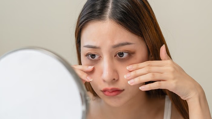 Dark Circles Under Eyes