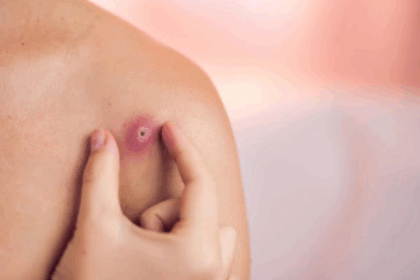Boils and Pimples Causes