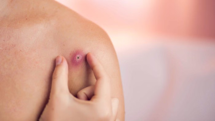 Boils and Pimples Causes
