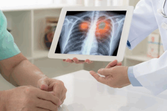 Pulmonary fibrosis blindness