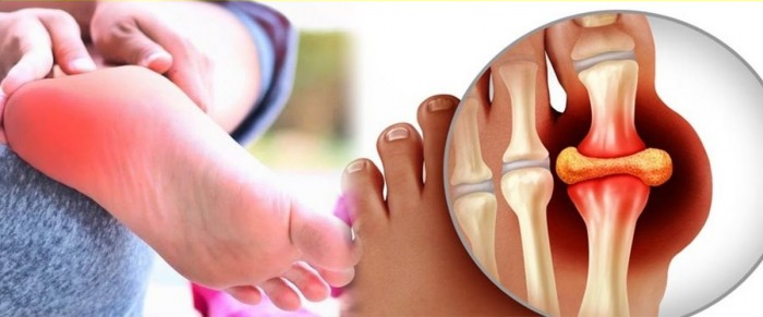 High Uric Acid: યુરિક એસિડ વધવાથી યુવાનોમાં ગંભીર આરોગ્ય સમસ્યાઓનું જોખમ,આ બીમારીઓનો રહે છે ખતરો 1 High Uric Acid