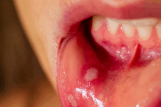 Mouth Ulcers Home Remedies