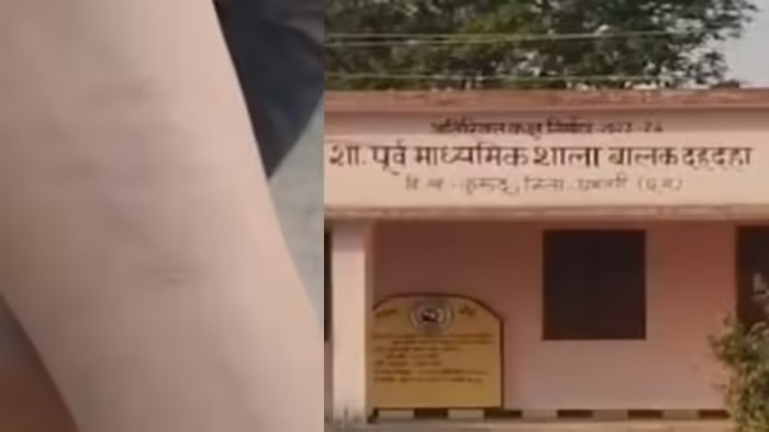 Chhattisgarh News: શાળામાં ફેલાયો રહસ્યમયી 'બ્લેડ ટાસ્ક'નો ડર: ધમતરીમાં ૩૫ વિદ્યાર્થીઓએ એકસાથે કાપ્યા પોતાના હાથ; જૂથમાં આત્મઘાતી પગલાં પાછળ શું કોઈ ગેમ કે નશો છે જવાબદાર? 1 v9kh2uhg