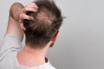 Male Baldness Prevention Tips