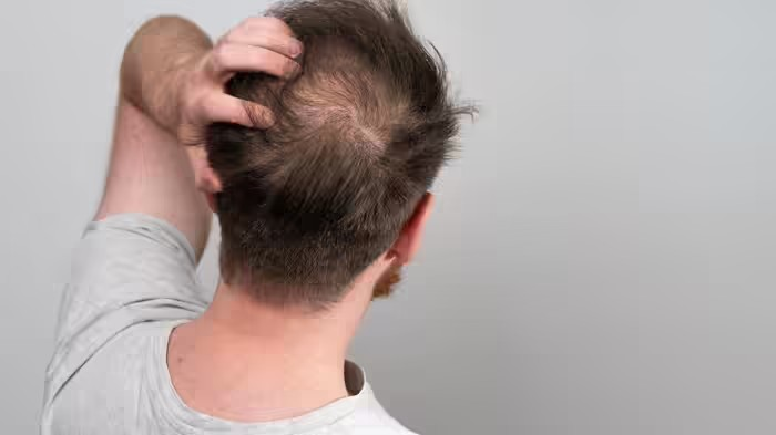 Male Baldness Prevention Tips