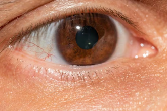 Retinal Detachment Treatment