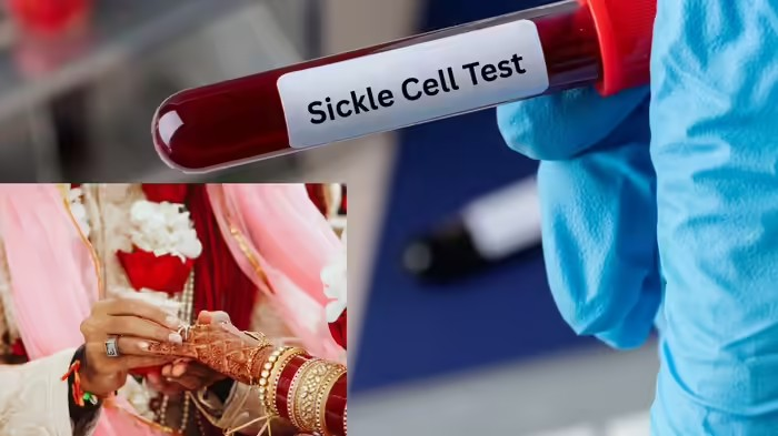 World Sickle cell awareness day: સિકલ સેલ એનિમિયાથી બચવા માટે પ્રી-મેરિટલ ટેસ્ટ કેમ છે અનિવાર્ય? જાણો નિષ્ણાતોનો અભિપ્રાય 1 World Sickle cell awareness day