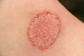 Fungal Infection Strategy