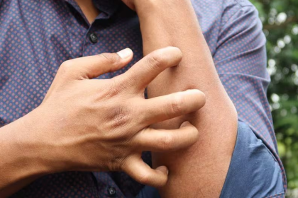 Bug Bite Itching