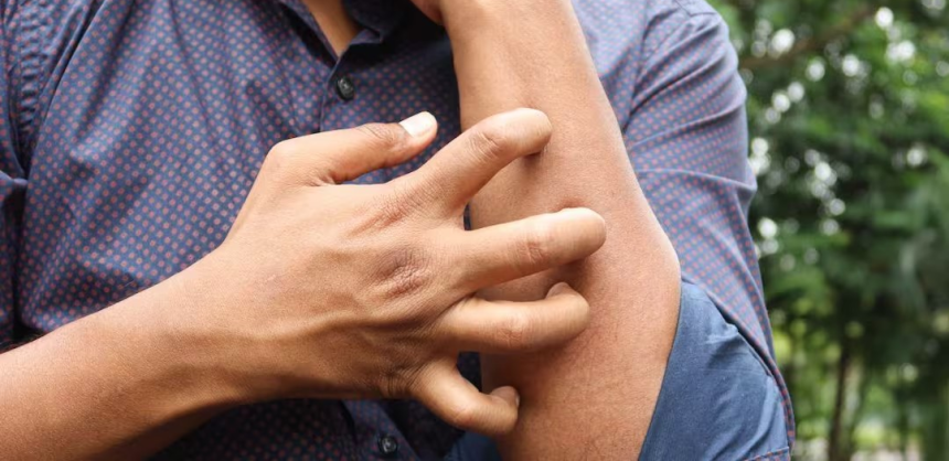 Bug Bite Itching