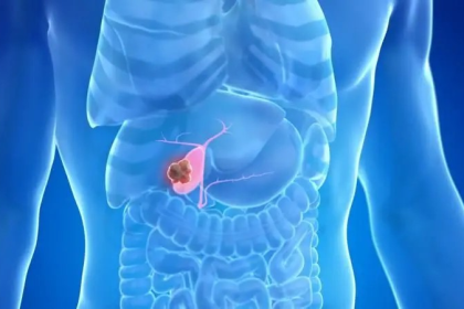 Gallbladder Stone