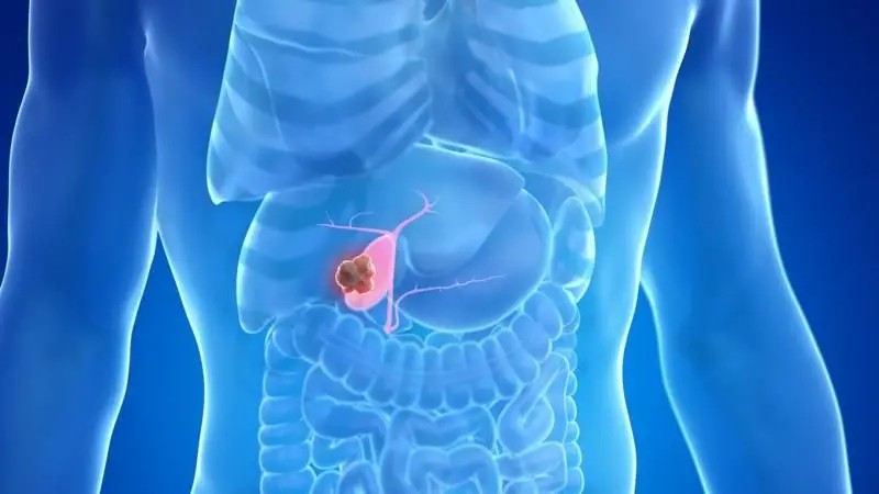Gallbladder Stone: ગોલ બ્લેડરમાં પથરી કેવી રીતે બને છે? લક્ષણો, તપાસ અને સારવાર વિશે સંપૂર્ણ માહિતી 1 Gallbladder Stone