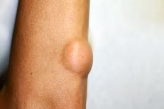 Body Lump