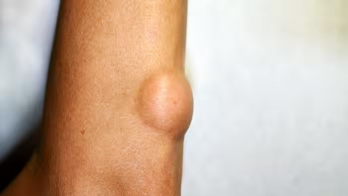 Body Lump: દરેક ગાંઠ કેન્સર નથી, પરંતુ આ લક્ષણો દેખાય તો તરત ડૉક્ટરને બતાવો 1 Body Lump