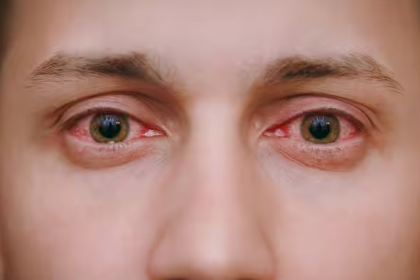 Eye Redness Causes