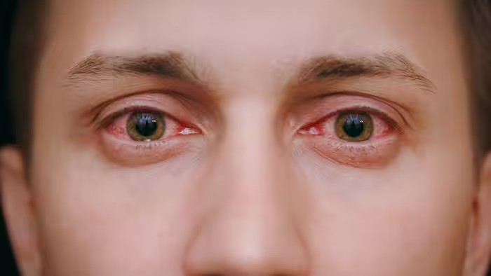 Eye Redness Causes: સ્ક્રીન ટાઈમ ઓછો હોવા છતાં આંખો હંમેશા લાલ રહે છે? નાની રક્તવાહિનીઓ ફાટી ગઈ હોઈ શકે, જાણો તમામ કારણો 1 Eye Redness Causes