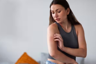 Mosquito Bite Skeeter Syndrome