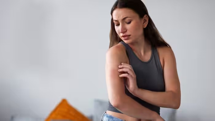 Mosquito Bite Skeeter Syndrome: મચ્છરના કરડ્યા બાદ નાનું લાલ નિશાન કે ખંજવાળ સામાન્ય, પરંતુ આ લક્ષણો દેખાય તો હોઈ શકે છે સ્કિટર સિન્ડ્રોમ 1 Mosquito Bite Skeeter Syndrome