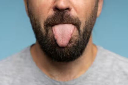 Yellow Tongue Causes